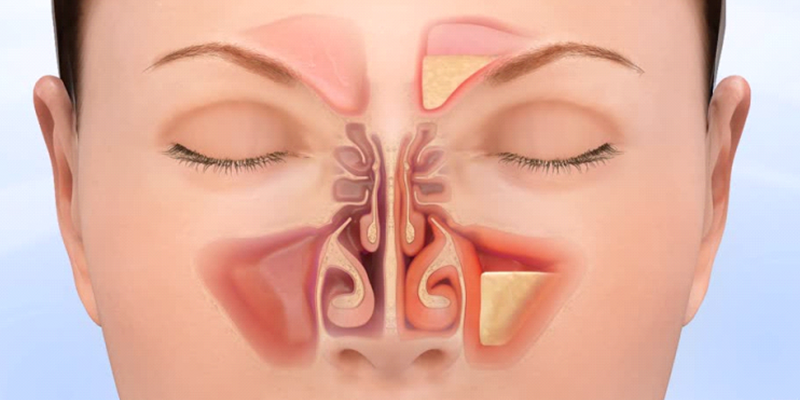 Sinus Surgeries